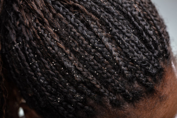 Woman in braids with dandruff